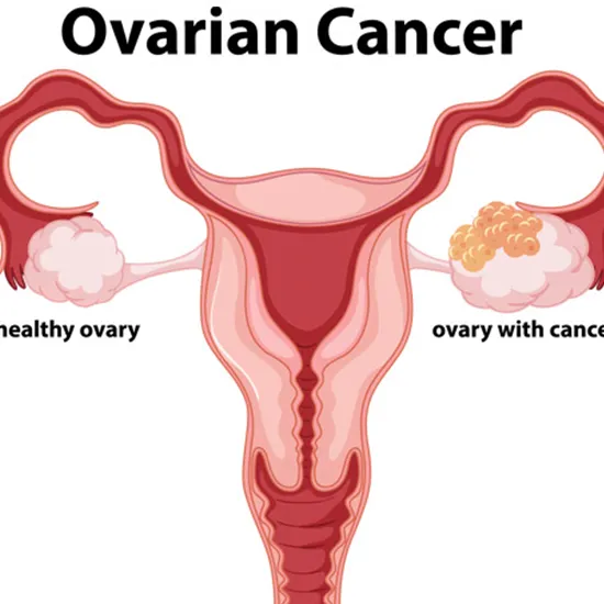ROMA (Risk Of Ovarian Malignancy Algorithm)